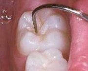 Dente vulnerável á cárie dentária Dente vulnerável á cárie dentária